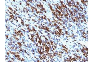 Formalin-fixed, paraffin-embedded human Rhabdomyosarcoma stained with Myogenin Mouse Monoclonal Antibody (MGN185+F5D) (Myogenin Antikörper  (AA 30-224))