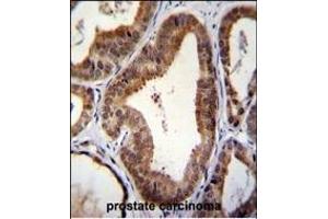 SHQ1 Antibody (N-term) (ABIN655661 and ABIN2845133) immunohistochemistry analysis in formalin fixed and paraffin embedded human prostate carcinoma followed by peroxidase conjugation of the secondary antibody and DAB staining. (SHQ1 Antikörper  (N-Term))