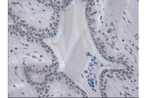 Immunohistochemical staining of paraffin-embedded breast using anti-IL-3 (ABIN2452543) mouse monoclonal antibody.