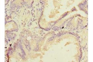 Immunohistochemistry of paraffin-embedded human prostate cancer using ABIN7172922 at dilution of 1:100