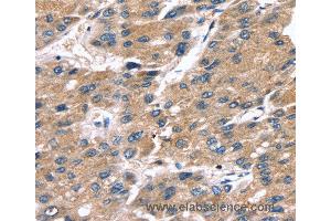 Immunohistochemistry of Human liver cancer using SRGN Polyclonal Antibody at dilution of 1:25 (SRGN Antikörper)