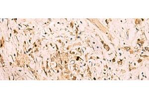 Immunohistochemistry of paraffin-embedded Human gastric cancer tissue using SGTA Polyclonal Antibody at dilution of 1:75(x200) (SGTA Antikörper)