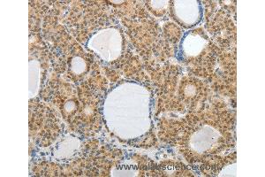 Immunohistochemistry of Human thyroid cancer using AKAP6 Polyclonal Antibody at dilution of 1:30 (AKAP6 Antikörper)