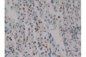 DAB staining on IHC-P; Samples: Human Lung cancer Tissue (HMGXB4 Antikörper  (AA 264-540))