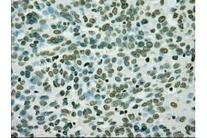 Immunohistochemical staining of paraffin-embedded Adenocarcinoma of breast tissue using anti-SILV mouse monoclonal antibody. (Melanoma gp100 Antikörper)