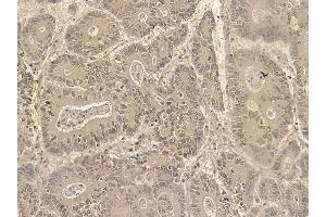 FAM114A2 Mouse Monoclonal Antibody at 1/100 staining human colorectal cancer by IHC-P. (FAM114A2 Antikörper)