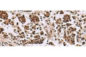 Immunohistochemistry of paraffin-embedded Human breast cancer tissue using SIK3 Polyclonal Antibody at dilution of 1:60(x200) (SIK3 Antikörper)