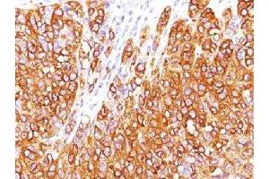 IHC testing of human melanoma stained with MART-1 antibody (M2-7C10). (MLANA Antikörper)