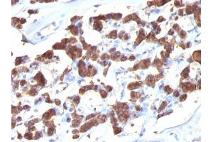 Formalin-fixed, paraffin-embedded human Thyroid stained with Thyroglobulin Ab (2H11 + 6E1).