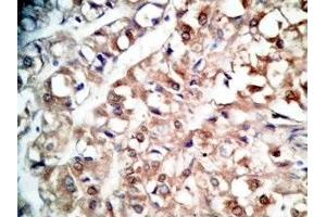 Human kidney cancer tissue was stained by rabbit Anti-BNP-45 (Mouse) Antiserum (BNP-45 Antikörper  (AA 51-95))