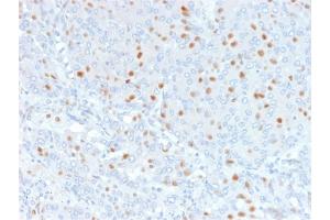 Formalin-fixed, paraffin-embedded human Bladder Carcinoma stained with Annexin A1 Mouse Monoclonal Antibody (6E4/3). (Annexin a1 Antikörper)