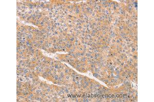 Immunohistochemistry of Human liver cancer using CD2AP Polyclonal Antibody at dilution of 1:70