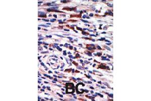 Formalin-fixed and paraffin-embedded human cancer tissue reacted with PRKCH polyclonal antibody  , which was peroxidase-conjugated to the secondary antibody, followed by AEC staining . (PKC eta Antikörper  (N-Term))