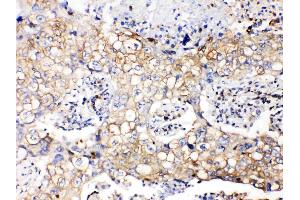 GAPDH was detected in paraffin-embedded sections of human lung cancer tissues using rabbit anti- GAPDH Antigen Affinity purified polyclonal antibody (Catalog # ) at 1 µg/mL. (GAPDH Antikörper  (AA 136-335))