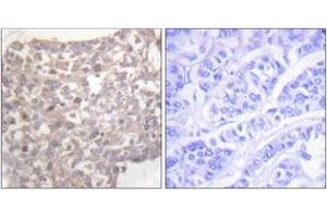 Immunohistochemistry analysis of paraffin-embedded human breast carcinoma tissue, using Tubulin gamma Antibody. (TUBG1 Antikörper  (AA 386-435))