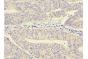 Immunohistochemistry of paraffin-embedded human endometrial cancer using ABIN7142352 at dilution of 1:100