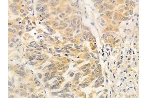 ABIN6257475 and ABIN6275440 at 1/100 staining human lung squamous cell carcinoma by IHC-P.