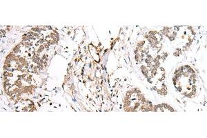 Immunohistochemistry of paraffin-embedded Human esophagus cancer tissue using BAG2 Polyclonal Antibody at dilution of 1:40(x200) (BAG2 Antikörper)