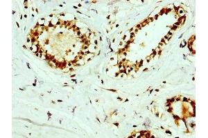 IHC image of ABIN7167302 diluted at 1:400 and staining in paraffin-embedded human breast cancer performed on a Leica BondTM system. (RAB35 Antikörper  (AA 1-201))