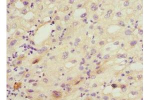 Immunohistochemistry of paraffin-embedded human liver cancer using ABIN7149242 at dilution of 1:100 (CYP2C18 Antikörper  (AA 231-490))