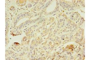 Immunohistochemistry of paraffin-embedded human breast cancer using ABIN7176718 at dilution of 1:100 (AZGP1 Antikörper  (AA 61-210))