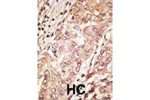 Formalin-fixed and paraffin-embedded human hepatocellular carcinoma tissue reacted with TDGF1 polyclonal antibody  , which was peroxidase-conjugated to the secondary antibody, followed by AEC staining. (TDGF1 Antikörper  (N-Term))