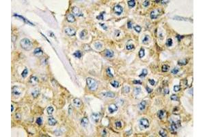 Immunohistochemistry analyzes of DAPP1 antibody in paraffin-embedded human breast carcinoma tissue. (DAPP1 Antikörper)