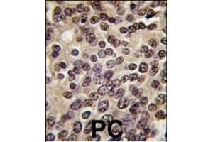 Formalin-fixed and paraffin-embedded human prostata carcinoma tissue reacted with PKN beta antibody (C-term), which was peroxidase-conjugated to the secondary antibody, followed by DAB staining. (PKN beta Antikörper  (C-Term))