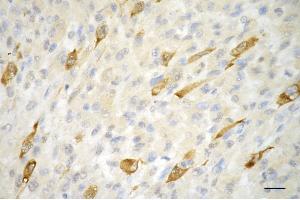 Immunohistochemistry was performed on paraffin-embedded human melanoma using phospho-CDK2 (Thr14) antibody (ABIN7798210), 1:200). (Rekombinanter CDK2 Antikörper  (pThr14))