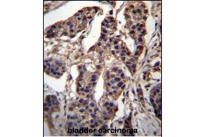 CABIN486182 and ABIN1535563 Antibody (N-term) (ABIN657088 and ABIN2837891) immunohistochemistry analysis in formalin fixed and paraffin embedded human bladder carcinoma followed by peroxidase conjugation of the secondary antibody and DAB staining.