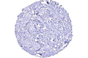 SDH deficient paraganglioma lacking granular SDHB staining in all tumor cells while stroma cells are positive. (Rekombinanter SDHB Antikörper)