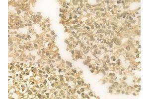 ABIN6265862 and ABIN6279403 at 1/100 staining human glioblastoma by IHC-P.