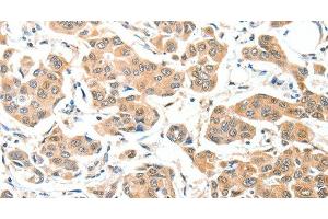 Immunohistochemistry of paraffin-embedded Human breast cancer tissue using ADCK1 Polyclonal Antibody at dilution 1:40 (ADCK1 Antikörper)