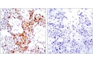 Immunohistochemistry analysis of paraffin-embedded human breast carcinoma, using ATF2 (Phospho-Thr69 or 51) Antibody.