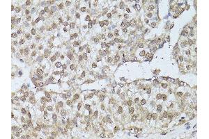 Immunohistochemistry of paraffin-embedded human breast cancer using ESR1 antibody. (Estrogen Receptor alpha Antikörper  (AA 1-190))