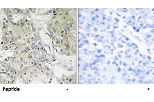 Immunohistochemistry analysis of paraffin-embedded human breast carcinoma tissue, using ANO9 polyclonal antibody . (ANO9 Antikörper)