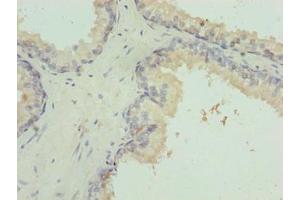 Immunohistochemistry of paraffin-embedded human prostate cancer using ABIN7156409 at dilution of 1:100 (Integrator Complex Subunit 14 (INTS14) (AA 231-518) Antikörper)