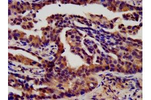 IHC image of ABIN7152837 diluted at 1:450 and staining in paraffin-embedded human lung cancer performed on a Leica BondTM system. (FGFR3 Antikörper  (AA 23-375))
