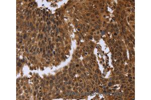 Immunohistochemistry of Human cervical cancer using FGFRL1 Polyclonal Antibody at dilution of 1:40