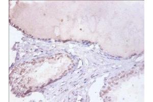 Immunohistochemistry of paraffin-embedded human prostate tissue using ABIN7155104 at dilution of 1:100 (HNRNPD/AUF1 Antikörper  (AA 18-355))