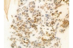 ABIN6265557 and ABIN6278407 at 1/100 staining human lung squamous cell carcinoma by IHC-P. (THOC1 Antikörper  (C-Term))