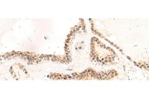 Immunohistochemistry of paraffin-embedded Human thyroid cancer tissue using RPL13A Polyclonal Antibody at dilution of 1:95(x200) (RPL13A Antikörper)