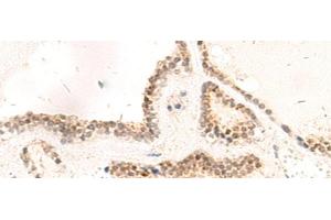 Immunohistochemistry of paraffin-embedded Human thyroid cancer tissue using RPL13A Polyclonal Antibody at dilution of 1:95(x200) (RPL13A Antikörper)