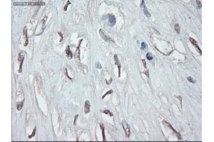 Immunohistochemical staining of paraffin-embedded Carcinoma of pancreas using anti-GATA4 (ABIN2452678) mouse monoclonal antibody. (GATA4 Antikörper  (AA 296-442))