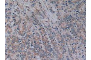 IHC-P analysis of Human Prostate Gland Cancer Tissue, with DAB staining. (NT5C3 Antikörper  (AA 52-336))