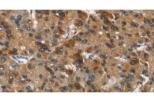 Immunohistochemistry of paraffin-embedded Human liver cancer tissue using DCC Polyclonal Antibody at dilution 1:70 (DCC Antikörper)