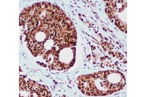 Immunohistochemical analysis of paraffin-embedded Prostate Cancer using hHR23b mouse mAb (1/100 dilution). (RAD23B Antikörper)