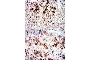 Immunohistochemical analysis of paraffin-embedded human medulla oblongata tissue (A) and liver cancer tissue (B) using TUBA8 monoclonal antobody, clone 2D6  with DAB staining. (TUBA8 Antikörper)