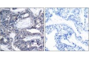 Immunohistochemistry analysis of paraffin-embedded human breast carcinoma, using MEK2 (Phospho-Thr394) Antibody. (MEK2 Antikörper  (AA 261-310))