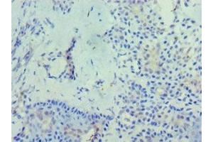 Immunohistochemistry of paraffin-embedded human breast cancer using ABIN7163439 at dilution of 1:100 (PHYH Antikörper  (AA 1-338))